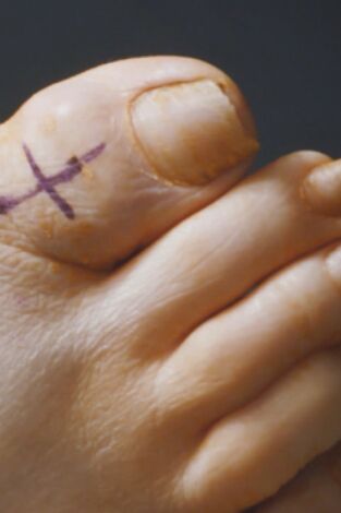 Los pies me están matando. Los pies me están...: Pie de martillo