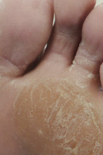 Imagen de Los pies me están...: Mi pie parece un queso parmesano - 1